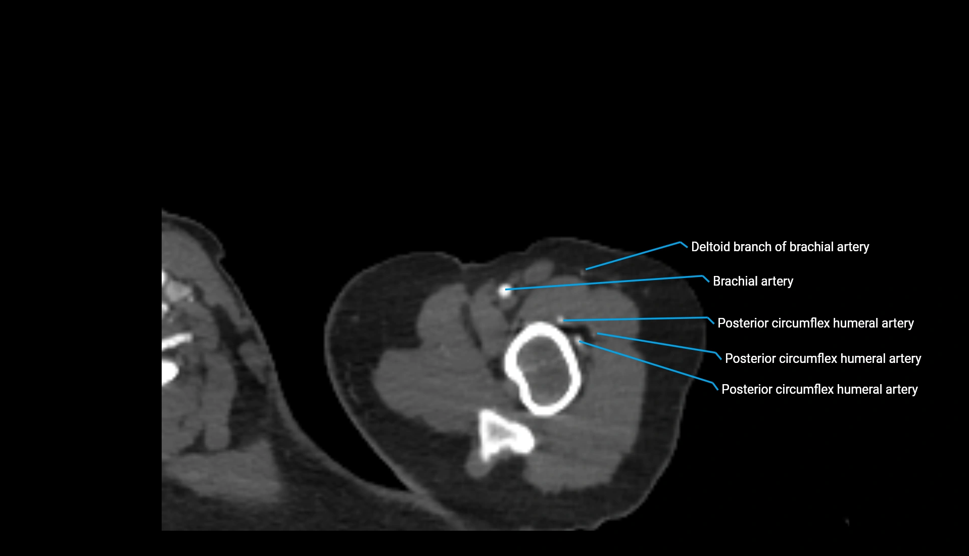 CTA upper limb axial cross sectional anatomy labelled image 312 (1).webp
